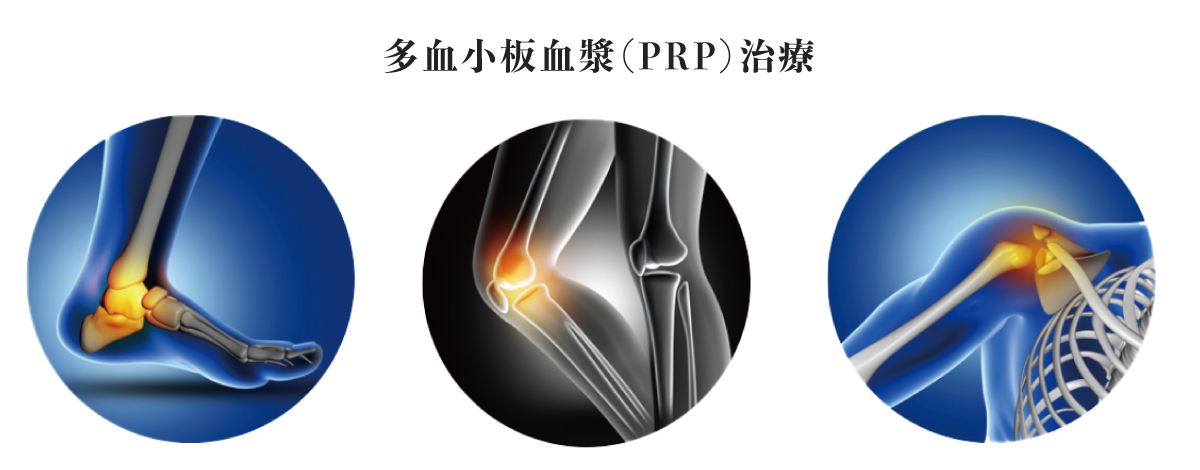 再生医療「PRP療法」